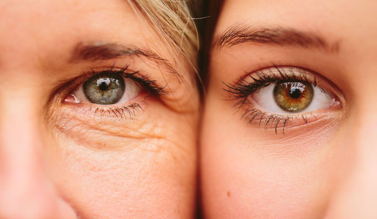 az öregedés jelei a szem körül
