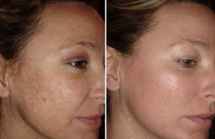 arcbőr lézeres fiatalítása fotók előtt és után